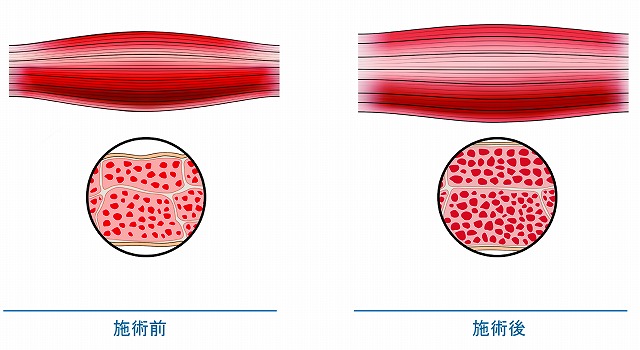 筋肉増加